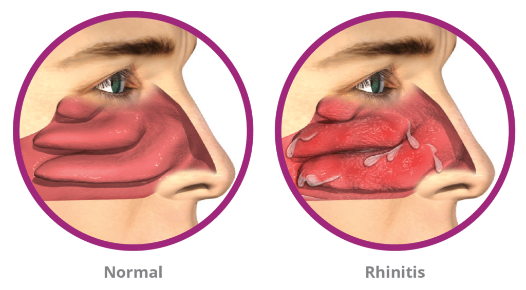 Normal vs Rhinitis